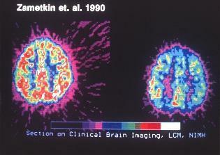 клинично сканиране на мозъка за adhd