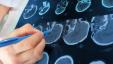 3D сканиране на мозъка може да повиши точността на диагнозата ADHD